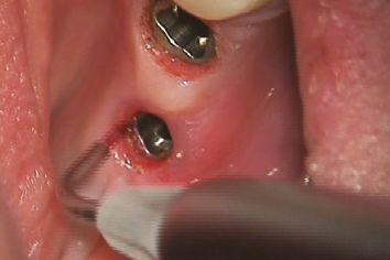 Odsłonięcie implantu dentystycznego